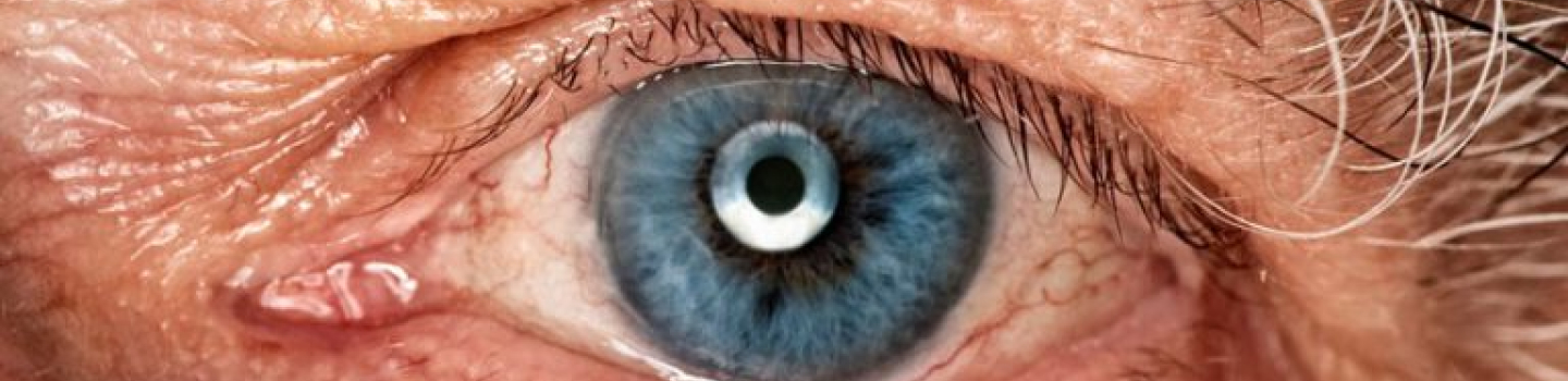 Cirugía de catarata